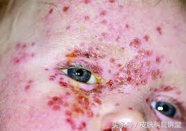 皮肤科疱疹,皮肤科一问一答