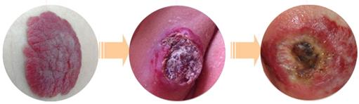 血管瘤严查,血管瘤怎么确定好坏