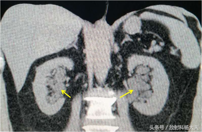 b超检查有肾积水ct为啥没查出来,ct显示左肾积水