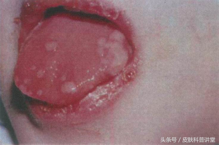 皮肤科疱疹,皮肤科一问一答