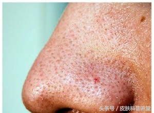 皮肤科医生毛孔粗大推荐的护肤品,毛孔粗大有黑头可以看皮肤科吗