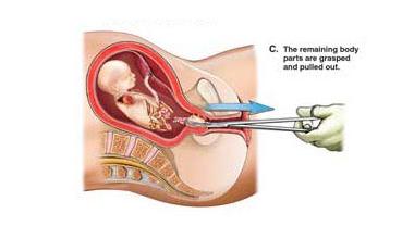 普通无痛人流真的不痛吗,无痛人流真的那么可怕吗