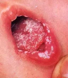 鹅鹅鹅鹅口疮，你需要知道这些