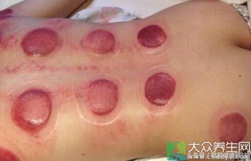 拔火罐印记是灰白颜色为什么,拔火罐的印子颜色代表了什么