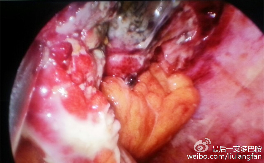 阑尾在哪个位置男左女右,阑尾的位置叫什么