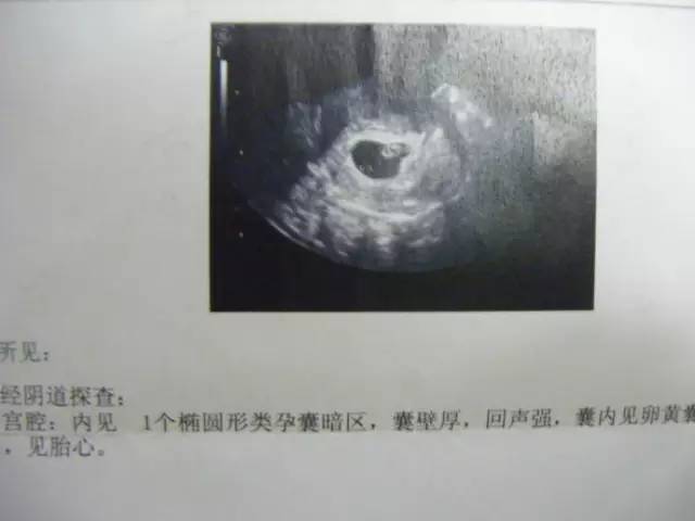 有了先兆流产怎么办最好,先兆流产最后保住了的真实经历