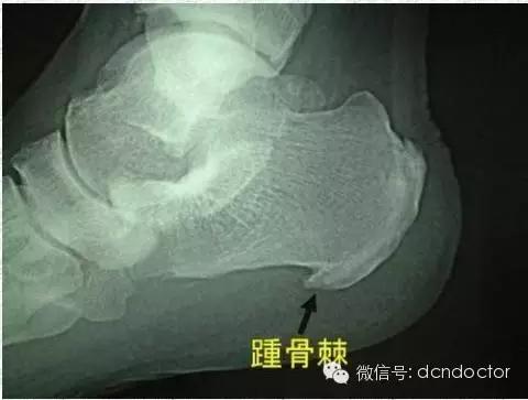 中医骨科小针刀治疗足跟痛,足跟痛看骨科好还是疼痛科好