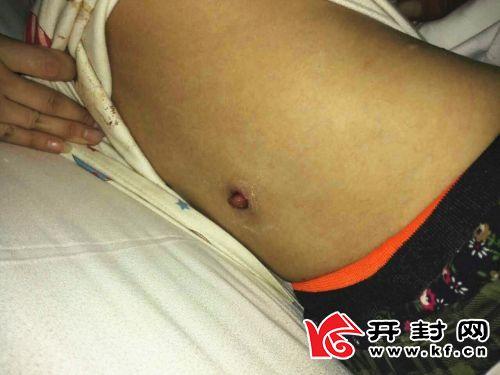 震惊!开封小女孩体内插入异物多日