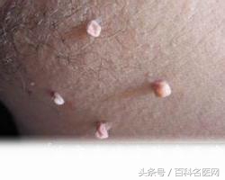 恶性肿瘤身上有很多包是咋回事,恶性肿瘤转移身上很多包块