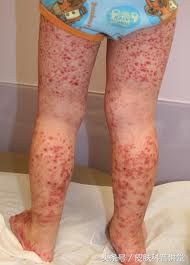 过敏性紫癜小腿胳膊有红点,过敏性紫癜一走路小腿就起红点