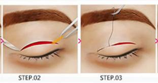 割双眼皮选医生真实经验分享,割双眼皮不能不知道的7个潜规则