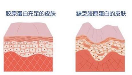 做完超声刀可以吃硬东西吗,超声刀做完必须用医用面膜吗