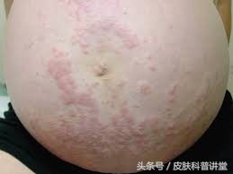 妊娠期瘙痒症出现皮疹怎么办,妊娠期皮肤瘙痒