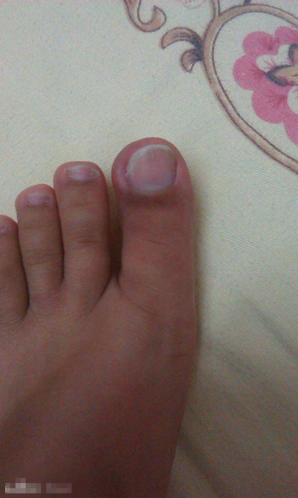 甲沟炎塞棉花法管用吗,甲沟炎塞棉花视频教程