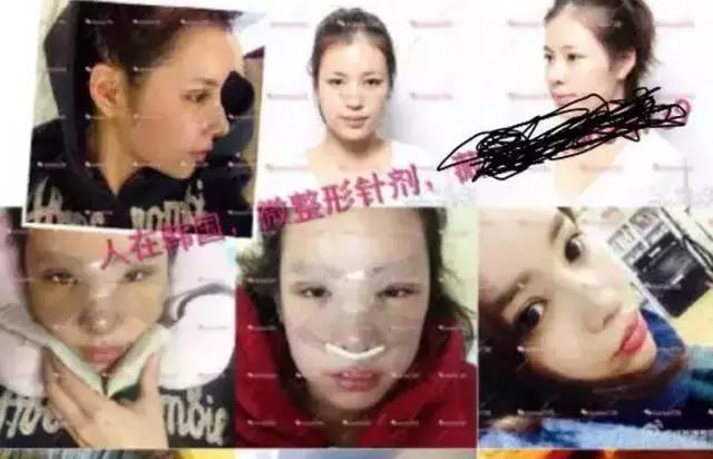 怀孕不小心打了瘦脸针会有影响吗,有没有孕妇打瘦脸针的