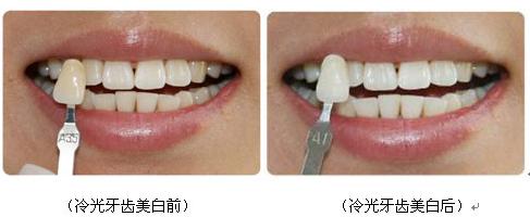 冷光美白牙齿两颗需要多少钱,冷光美白后牙齿酸疼怎么缓解
