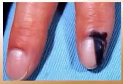 黑色素瘤突破真皮层,黑色素瘤是癌症的几率有多少