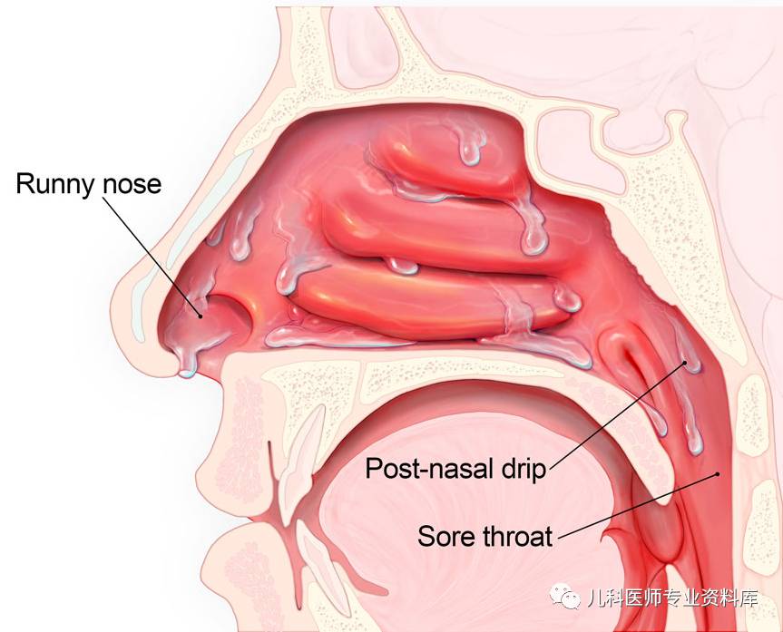 儿童黄鼻涕粘稠,儿童鼻炎鼻涕多