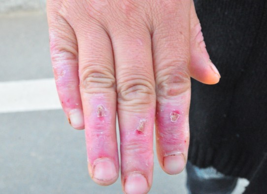 中药热敷局部对白癜风有疗效吗,治疗白斑的中药可以泡脚吗