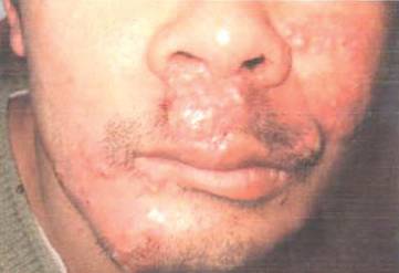 有一种病叫红斑丘疹,边界清晰发痒红斑有丘疹是湿疹吗