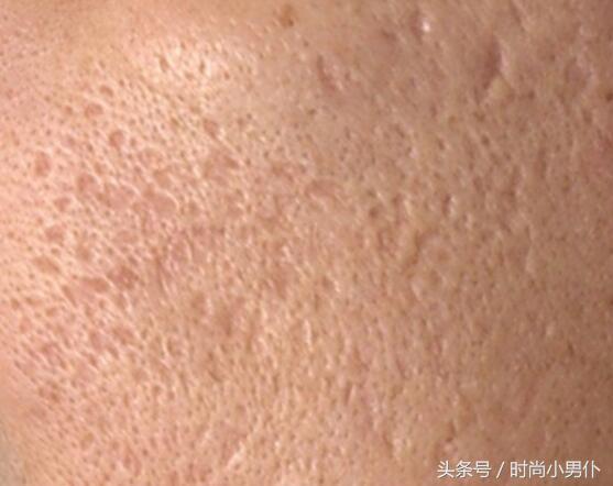 脸上30年凹凸疤痕怎么去除,脸上像月球表面怎么修复