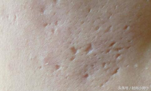 脸上像月球表面怎么修复,福建脸部坑洼性疤痕怎样淡化