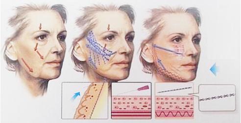 蛋白线埋线提升视频,蛋白线埋线提升注意事项