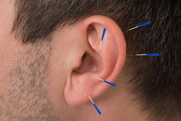 倪海厦针灸治疗脂肪肝,针灸可以治疗脂肪肝吗