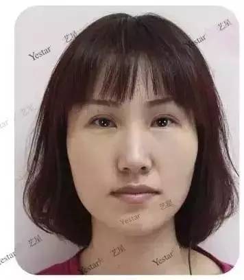 激光祛斑后还会反弹吗,激光祛斑后会不会反弹