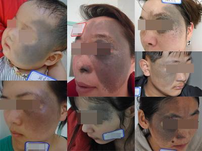 手肘蓝色的痣是胎记,胎记痣的颜色变浅像长到肉里了