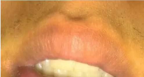 嘴唇上有几种颜色是什么病,嘴唇肿要警惕四种慢性病