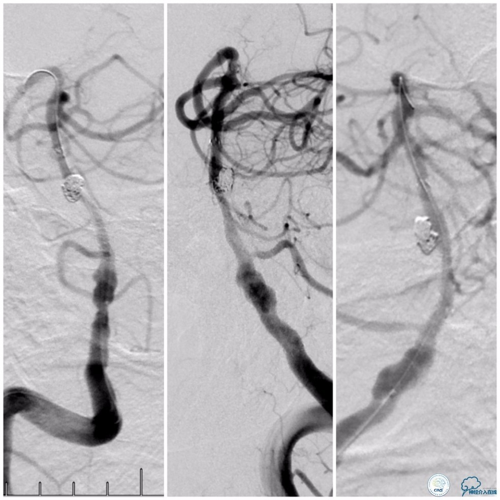 天坛周记|基底动脉狭窄合并动脉瘤血管内介入治疗一例