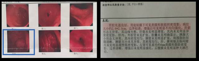 当EUS遇到“假瘤子”(二)——都是“隔壁老王”惹的祸(毗邻外压)