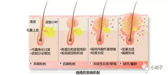 想治好痘痘、痘印、闭口你必须先知道这个！