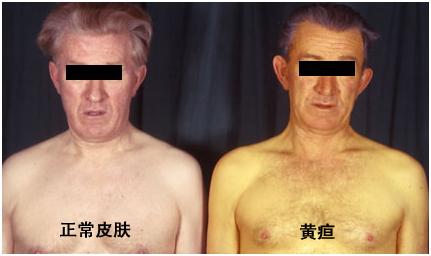 “小引流大作用”救命的胆道外引流管治疗晚期肿瘤性黄疸