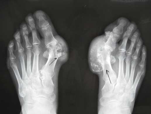 痛风草能治痛风吗,什么草治痛风最有效