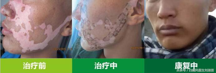 教你小妙招白癜风恢复快,治疗白癜风最省钱最快最好的方法