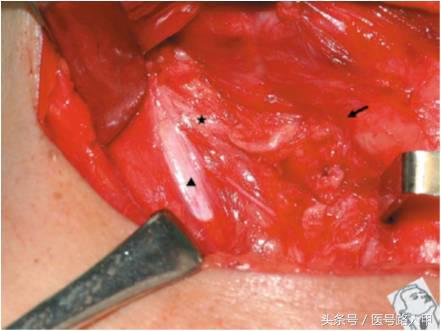 喉返神经的解剖视频,损伤喉上神经和喉返神经的区别