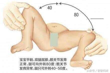 宝宝臀纹或大腿皮纹不对称怎么办,宝宝臀纹腿纹