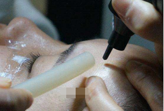 脸上的痣可以随便点吗,小孩脸上有痣可以随便点吗