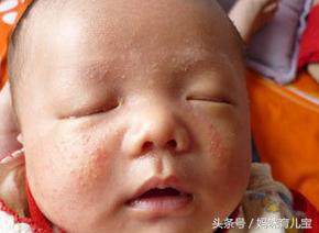 新生儿最易出现的10种皮肤问题,刚出生的婴儿有凸出皮肤病