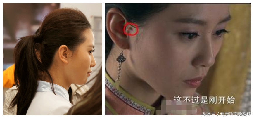 新生儿耳朵长个小附耳怎么造成的,5岁男童耳朵长副耳要住院吗