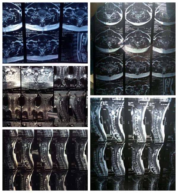 chiari畸形伴脊髓空洞且有轻微症状要手术吗？