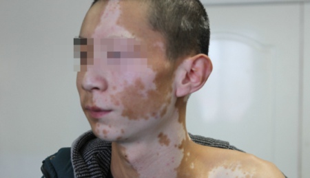 药离子和308治疗白癜风效果怎么样,308激光治疗白癜风医保报销吗