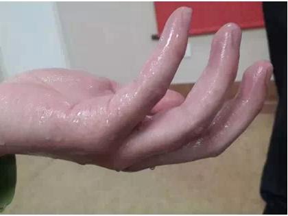 手足大量出汗怎么治疗,手足爱出汗是什么原因