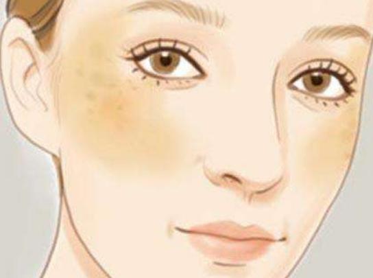 褐斑起因及调养,脸上出现褐斑是肝有问题吗