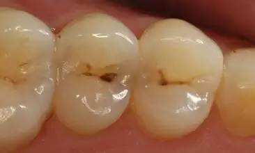 小洞不补大洞难补什么意思,5岁男童龋齿一个小洞处理办法