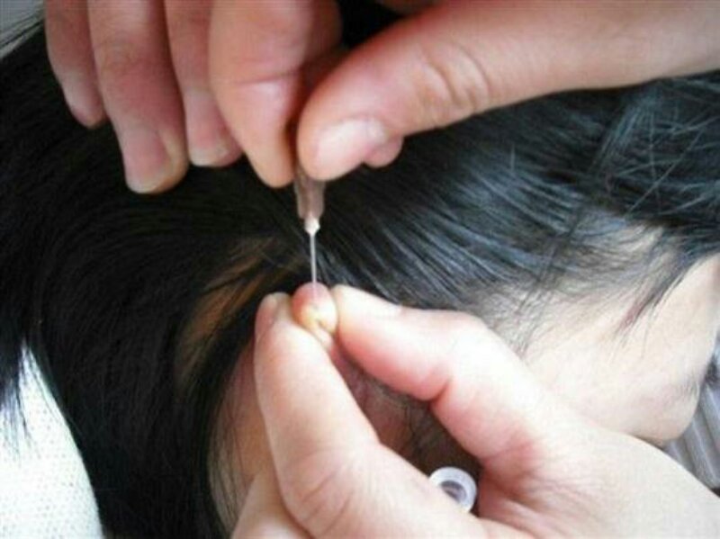 去除针眼中医疗法,针眼总不好怎么办