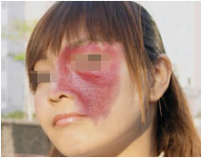 千奇百怪的胎记,各类胎记