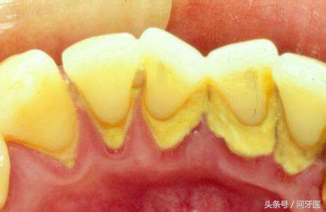 从牙缝中抠出一大块牙结石,从牙齿里面抠掉碎块很臭怎么消除